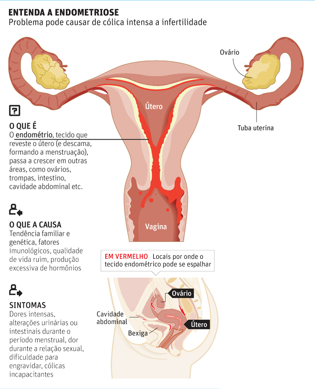 Menstruação retrógrada: saiba o que é e qual doença ela pode causar