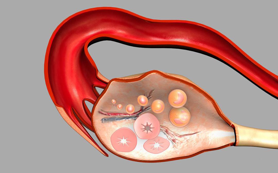 Образование округлое в яичнике